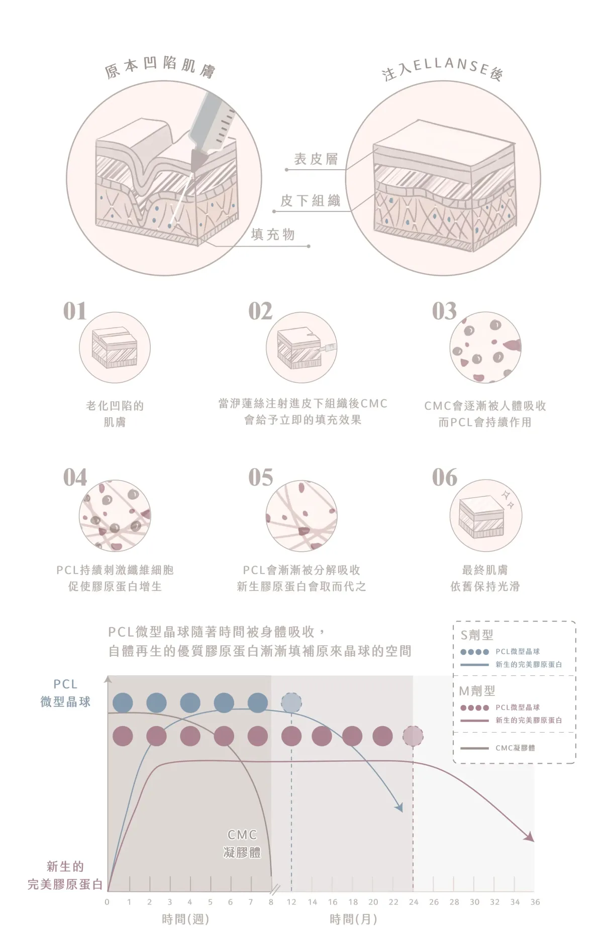 ELLANSÉ洢蓮絲少女針 - 填補臉部凹陷、撫平皺紋