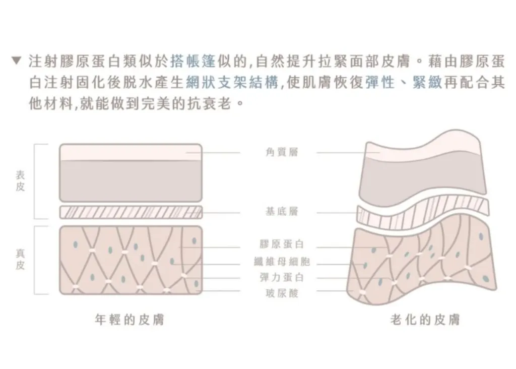 艾麗斯精靈針效果好嗎？填補臉部凹陷、改善皺紋的絕佳利器！